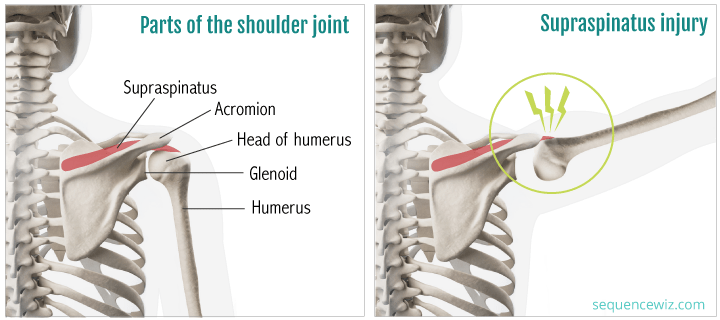 Pinching the supraspinatus by not allowing shoulder blade rotation